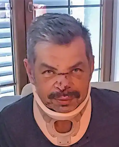 Nose broken off from face